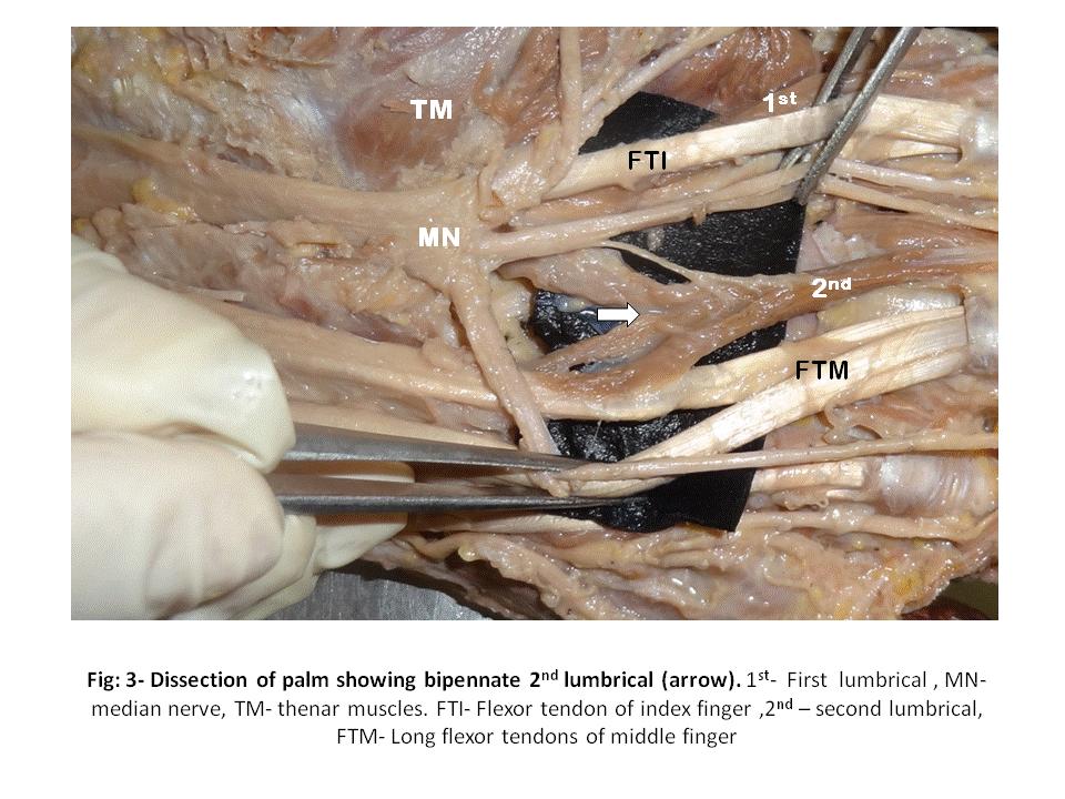 Plastic Surgery: An International Journal 4 Fig: 3- Dissection of Palm Showing Bipennate 2 nd Lumbrical