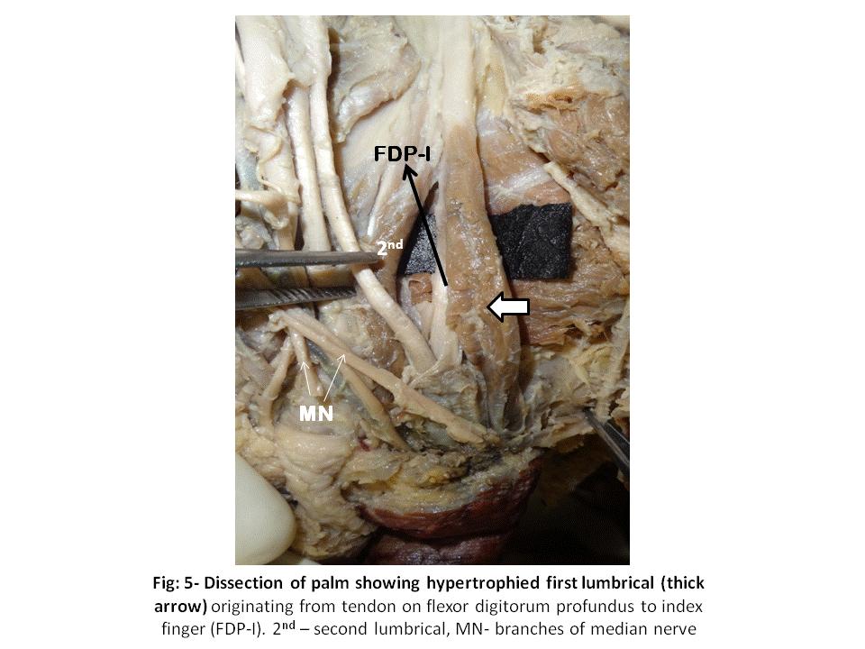 5 Plastic Surgery: An International Journal Fig: 5- Dissection of Palm Showing Hypertrophied First Lumbrical