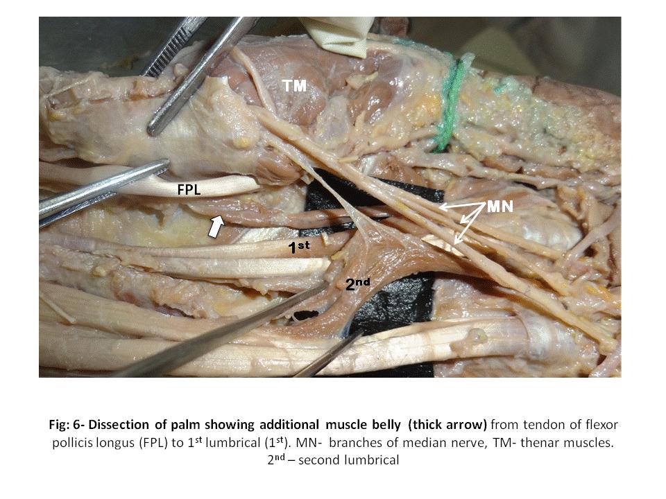 presence of additional muscle belly from the tendon of flexor pollicis longus were also observed (Fig 6).