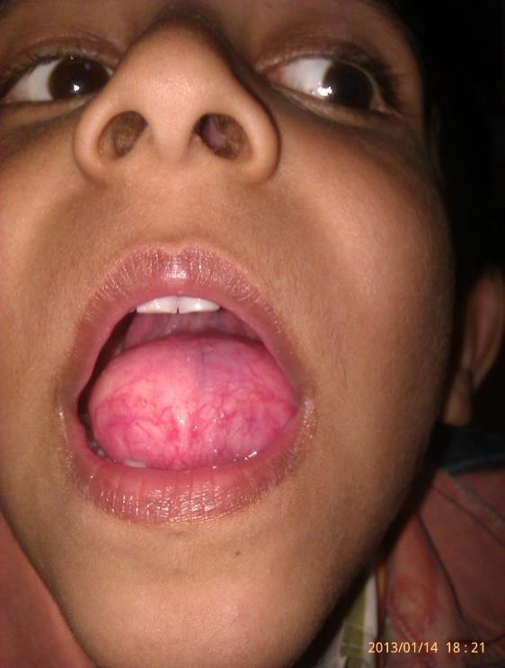 Large mass in oral cavity 5 years old boy with big size (6 4 cm) sublingual dermoid cyst was pushing the anterior part of the tongue and displacing the tongue superiorly and
