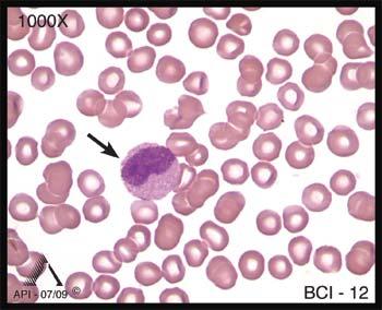 Also note that the segmented neutrophil has clumped and condensed nuclear chromatin. The cytoplasm in neutrophils has numerous small, pink, tan, or violet granules.