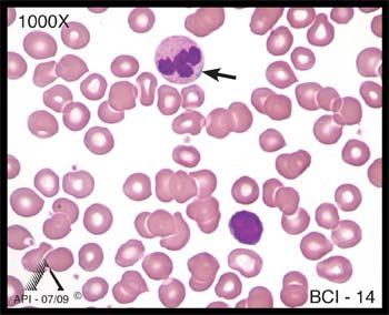 round nucleus Nuclear chromatin Dense, clumped Dense, clumped Dense, clumped Cytoplasm The cell in Image BCI-13 is a segmented neutrophil. However, it is not normal.