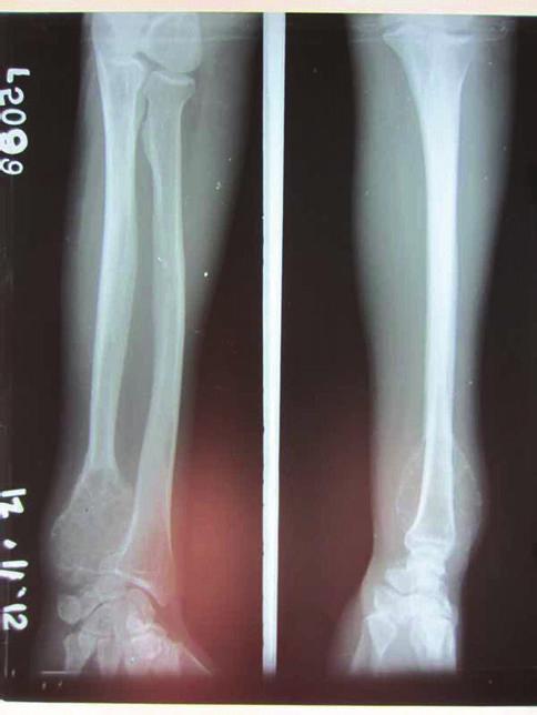 Plain radiography of the wrist in anteroposterior and lateral views showed a large expansile multiloculated lesion in the distal ulna with cortical thinning and no periosteal reaction (Figure 3).