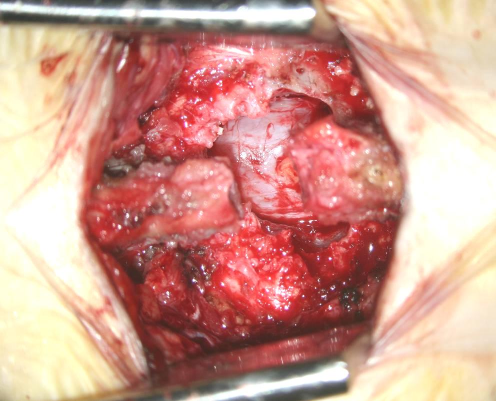 Methods (3) Coflex TM Skin incision, 4 cm PVM dissection Removal