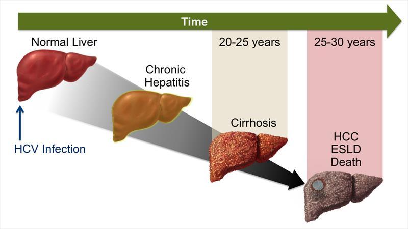 Natural History of Hepatitis C 15%-25% of HCV infections will resolve without treatment depending on age,
