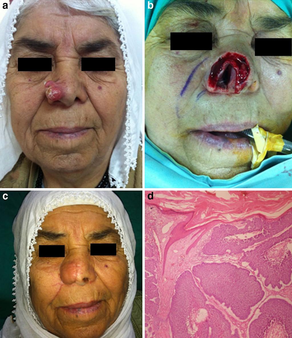 Page 3 of 6 Fig. 1 Nasal basal cell carcinoma. a The lesion had been growing rapidly for the last 6 months, b intraoperative appearance: Tumour was infiltrated the nasal mucosa.
