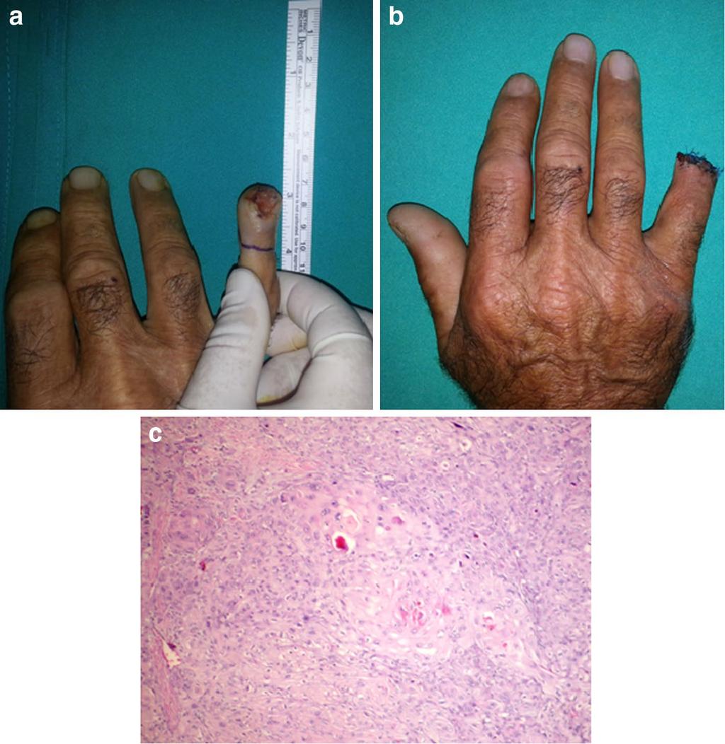 Page 4 of 6 Fig. 2 Fingertip squamous cell carcinoma. a Appearance of the lesion. b Surgical amputation was performed for bone invasion.