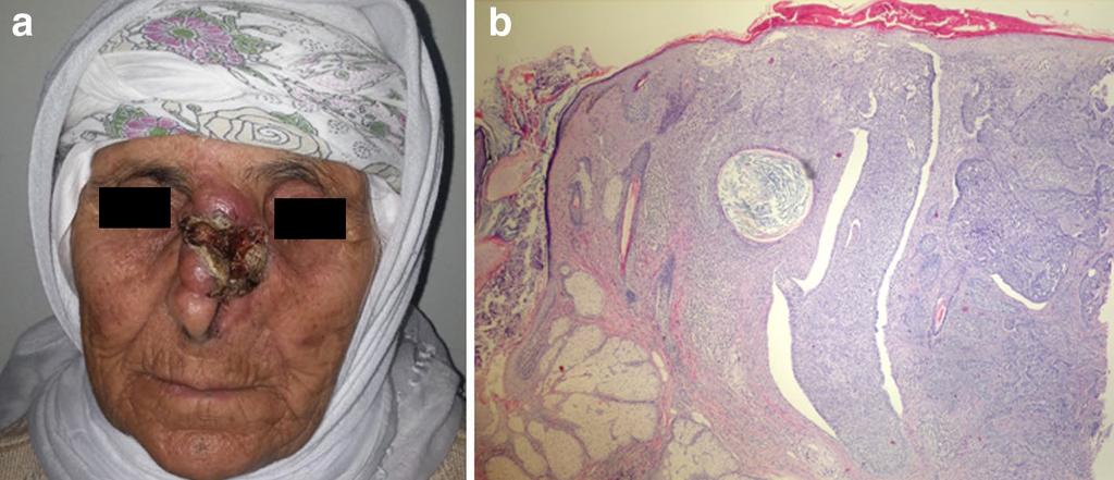 Page 5 of 6 Fig. 3 Nasal basal cell carcinoma. a The lesion had been growing rapidly after application of aqua regia for 2 years.