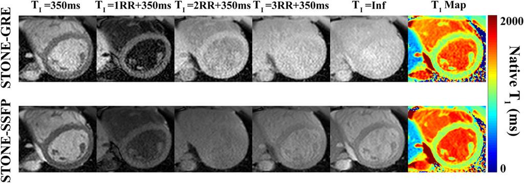 JANG ET AL. 1491 repeatability (STONE GRE, 1.78 ± 0.99 ms; STONE SSFP, 1.53 ± 0.64 ms, p > 0.05) compared with STONE SSFP.