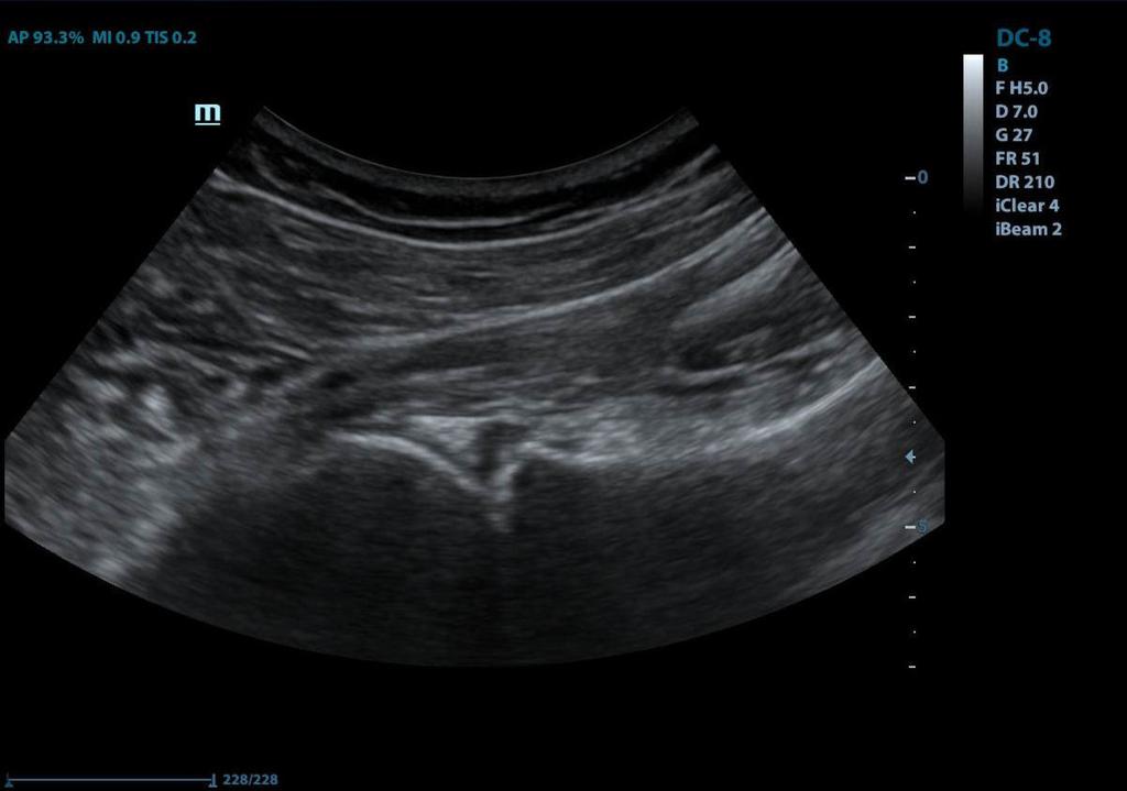 Fig. 3: SLAP 2 lesion.
