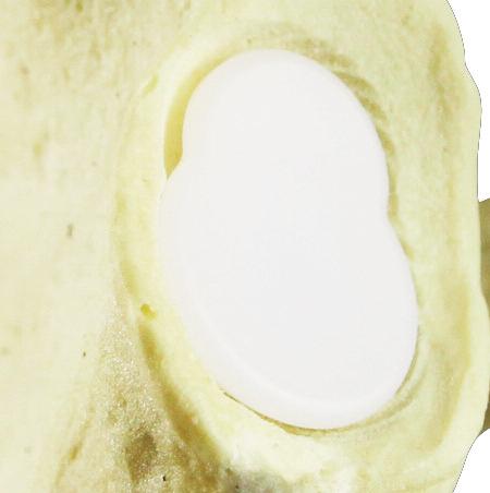 The HemiCAP GRS glenoid component is intended to interface and articulate with the humeral component when both articular surfaces of the joint are affected.