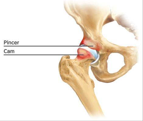 hip joint, making it a very deep part of the body for arthroscopic access. This is one reason why hip arthroscopy can be technically demanding.