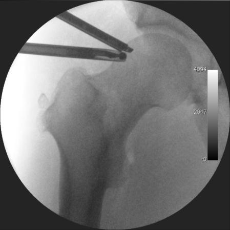 Cam-type femoroacetabular impingement Cam impingement is created by the abnormal development of the femoral headneck junction.