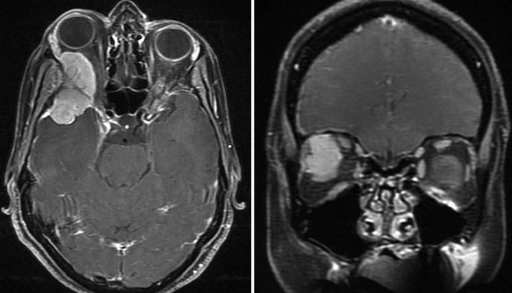 Proton-Radiotherapy for skull base tumors: Benign meningioma