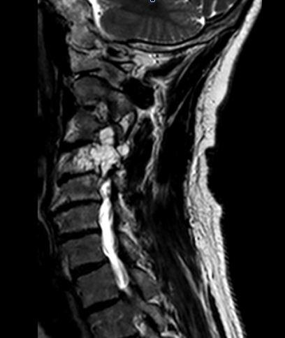 Chordoma of the Cervical Spine Patient: