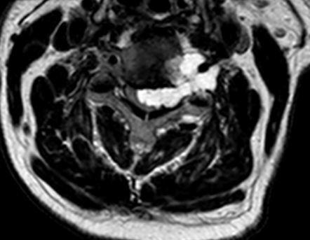 MRI 12/2012 Chordoma of C4 Vertebral