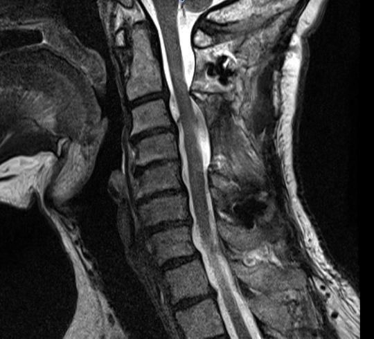 Chordoma of the Cervical Spine Patient: 63 y.o. M; Postop.
