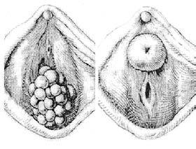 (botryoid sarcoma), B) urethral