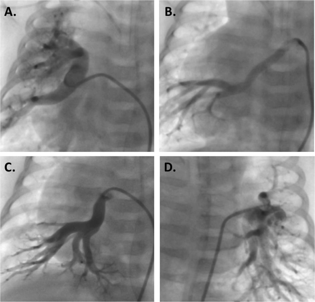 910 PATRICK ET AL Ann Thorac Surg MAPCAS WITH ATYPICAL ANATOMY 2017;104:907 16 Fig 4. (A,B,C,D) Angiogram of the patient with corrected transposition.