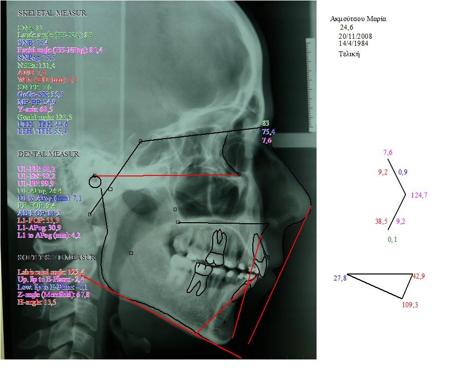 TRACING OF LATERAL SKULL RADIOGRAPH AT COMPLETION OF TREATMENT
