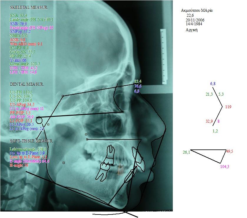 TRACING OF LATERAL SKULL RADIOGRAPH BEFORE TREATMENT