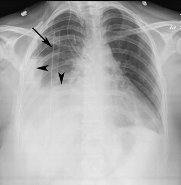 Radiographs of Chest Tubes 31