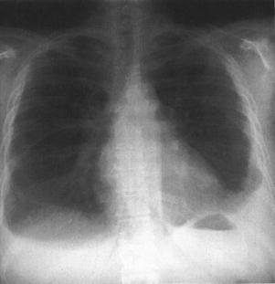 Pleural Effusion Associated with: Systemic edema Pulmonary edema Infection Infarction Lung CA Pneumonia 7 Pleural