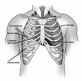 Open Pneumothorax Comes from opening in chest wall May see mediastinal