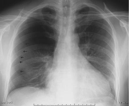 Closed Pneumothorax Communication of air from pleural space to lung