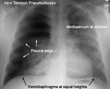 Pneumothorax 16 Pneumothorax with Pleural Effusion 17 Tension