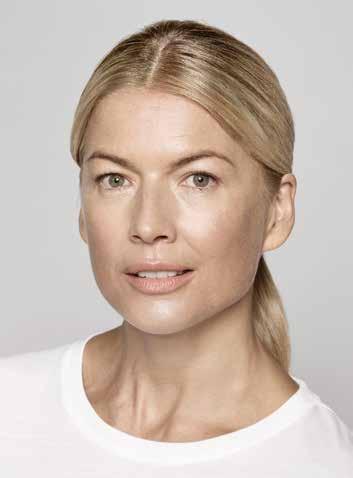 A natural-looking lift The lift you ve been looking for Cheeks Nasolabial Folds (smile lines) Basia Age 43 2 ml Restylane Lyft in