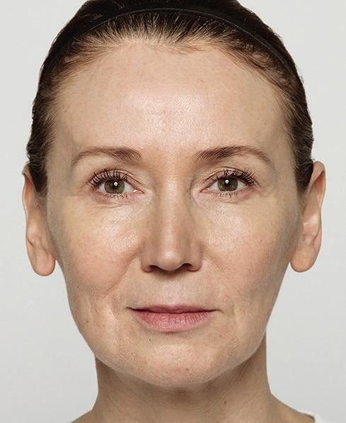 1 6 months after treatment, OVER 70% of subjects experienced improvement in the lines on the sides of their nose and mouth and 90% saw fuller cheeks.