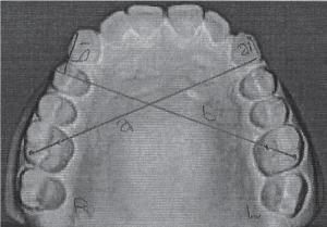 Table 4 Fig 2: Photocopy of upper model showing points marked on tip of canines (T), distobuccal cusp tip (DB) and mesiolingual cusp tip (ML) of maxillary permanent first molars. 2. A perpendicular is drawn from cusp tip of left canine to line a.