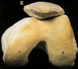 A ridge may be present between the trochlea and the anterior cortex of the femur and is more prominent medially.