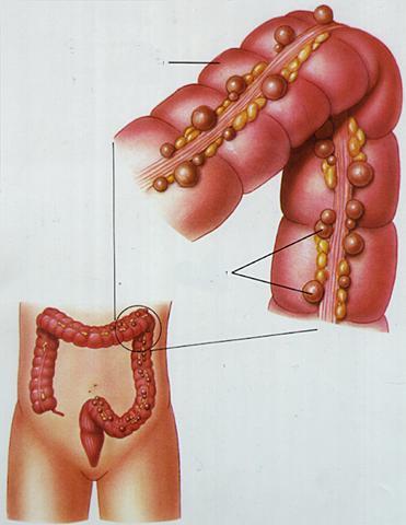 Diverticular Disease Caused from: hard, dry feces, characteristic of a low-fiber diet
