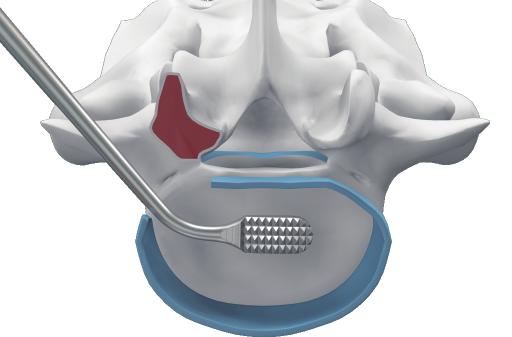 In order remove the tissue in the far lateral disc space, use the left or right angled curettes and the curved rongeur.