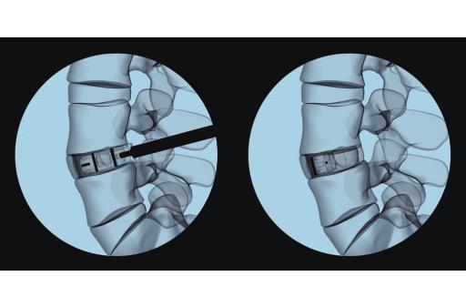 If necessary, apply controlled and light hammers on the applicator to advance the implant into the intervertebral disc space. Use fluoroscopy to confirm position and fit of the implant.