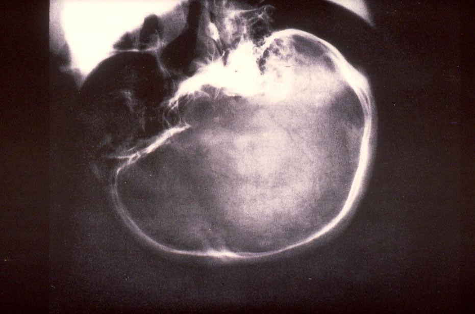 X-ray showing