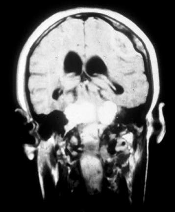) Feature Frequency (%) of symptomatic lesions Tumours of the nervous system 1 Bilateral vestibular schwannoma 85 Unilateral vestibular schwannoma 6 Meningiomas 45 Spinal tumours(meningiomas, 26