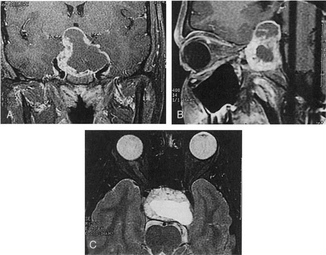 90 FREDA&POST Figure 4. A, Coronal enhanced T1 MR image of a 15-year-old boy presenting with a blind right eye and temporal visual field deficit in the left eye.
