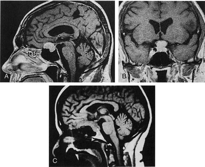 A, Sagittal MR image of a sellar and suprasellar tumor creeping along the planum sphenoidale typical of a meningioma. Pathology was a pituitary adenoma. B.