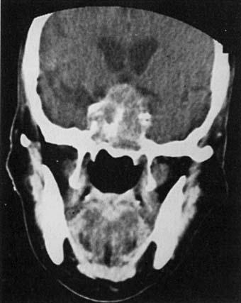 mass should increase the clinical suspicion for a metastatic lesion to the pituitary.', 24 On MR imaging, metastatic lesions to the pituitary can appear as enhancing sellar /suprasellar masses.