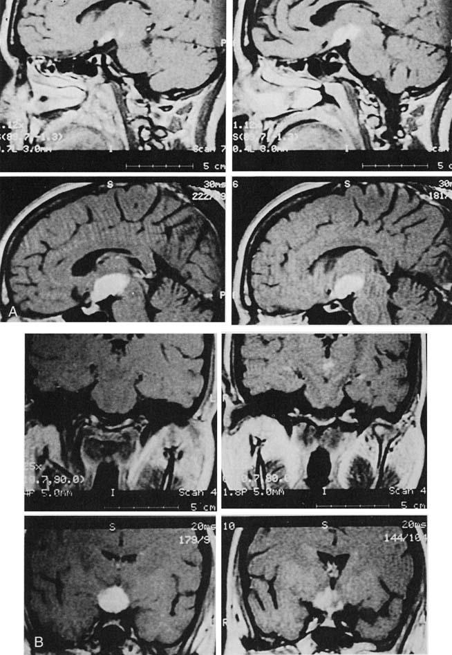 106 FREDA & POST Figure 19. Sagittal (A) and coronal (B) gadoliniumenhanced T1 MR images of a 50-yearold woman presenting with diabetes insipidus and memory loss.