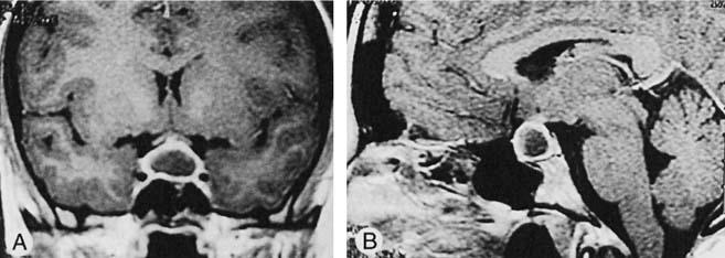 DIFFERENTIAL DIAGNOSIS OF SELLAR MASSES 109 Figure 21. Coronal (A) and sagittal (B) T1 -weighted gadolinium-enhanced MR images demonstrating a ring enhancing sellar mass distorting the optic chiasm.