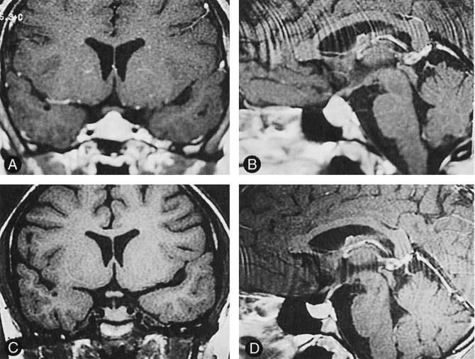DIFFERENTIAL DIAGNOSIS OF SELLAR MASSES 111 Figure 23. A and B, Coronal (A) and sagittal (B) T1-enhanced MR images in a 24-yearold woman with hypothyroidism. TSH level was greater than 1000 mlu/rnl.