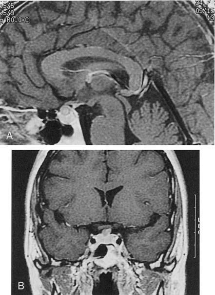 88 FREDA&POST Figure 2. A and B, MR images of a 34-year-old woman presenting with headache. Endocrinologic function and neurologic examination were normal.