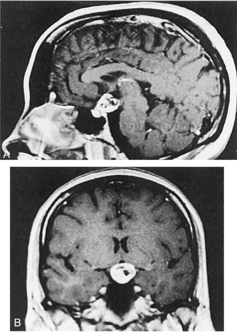 DIFFERENTIAL DIAGNOSIS OF SELLAR MASSES 89 Figure 3. A and 6, MR images of a 30-year-old woman presenting with visual loss. The enhanced study shows a mixed signal with solid and cystic components.