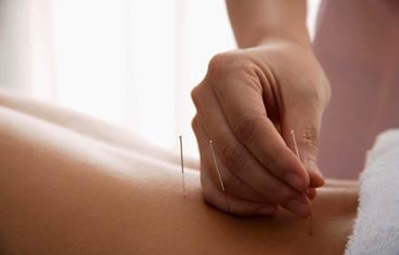 What is Acupuncture? Acupuncture is a technique in which practitioners stimulate specific points on the body most often by inserting thin needles through the skin.