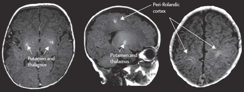 Hypoxic-ischemic brain injury CA1 region hippocampus Cerebral