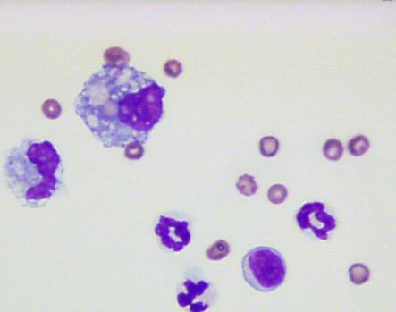 Hemorrhage may be seen in a number of neoplasms; however, aspirates from hemangiomas and hemangiosarcomas, due to the low cellularity of the sample, may only yield evidence of blood and hemorrhage.